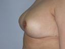 After Breast Reduction